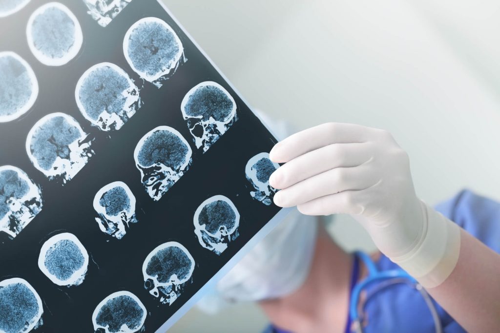 Isquemia cerebral: o que é necessário o estudante saber?