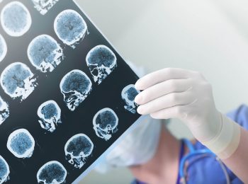 Isquemia cerebral: o que é necessário o estudante saber?