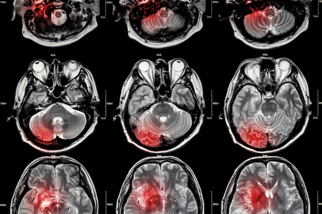 O que um estudante de medicina precisa saber sobre doenças cerebrovasculares