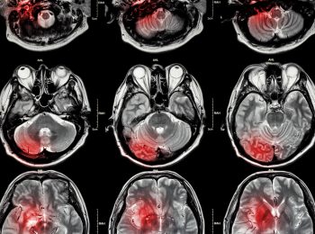 O que um estudante de medicina precisa saber sobre doenças cerebrovasculares