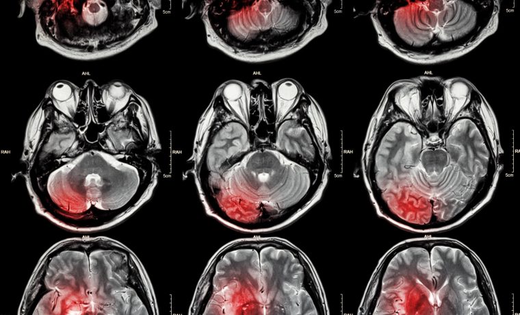 O que um estudante de medicina precisa saber sobre doenças cerebrovasculares